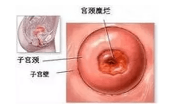 两个月不增大排除尖锐，深入了解尖锐湿疣的潜伏期与观察期